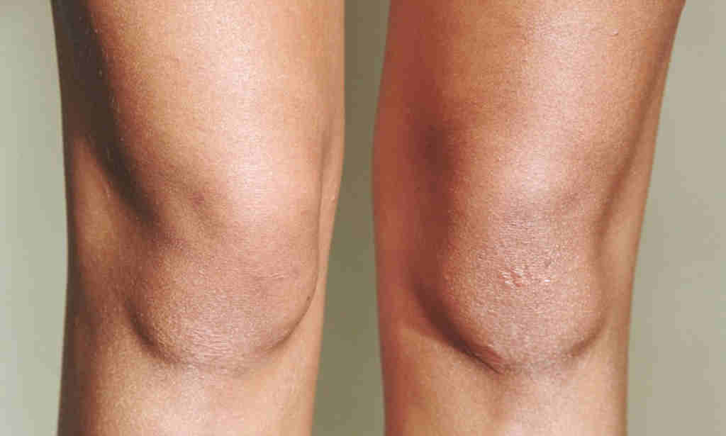Что делать, если шелушится кожа на коленях?