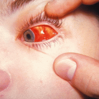 Что делать при кровоизлиянии в глаз?
