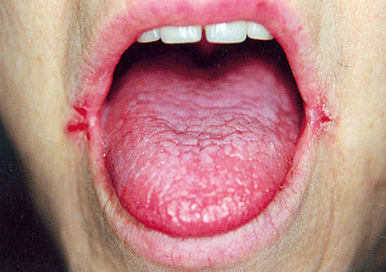 Почему появляются трещины в уголках губ