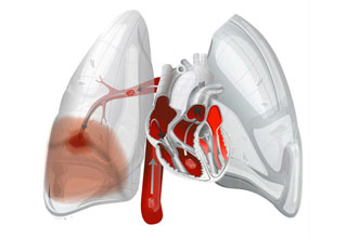﻿Тромбоэмболия легочной артерии
