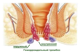 ﻿Тромбоз геморроидальных узлов