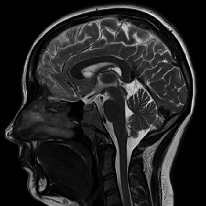 МРТ голвного мозга - горизонтальная проекция