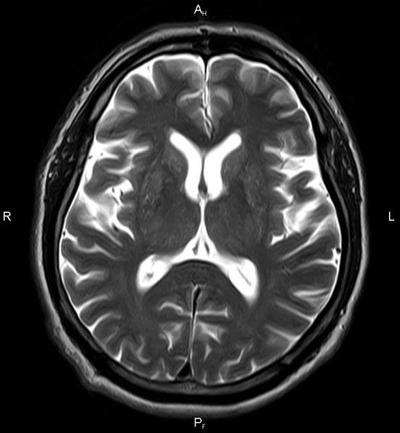 МРТ голвного мозга - вертикальная проекция