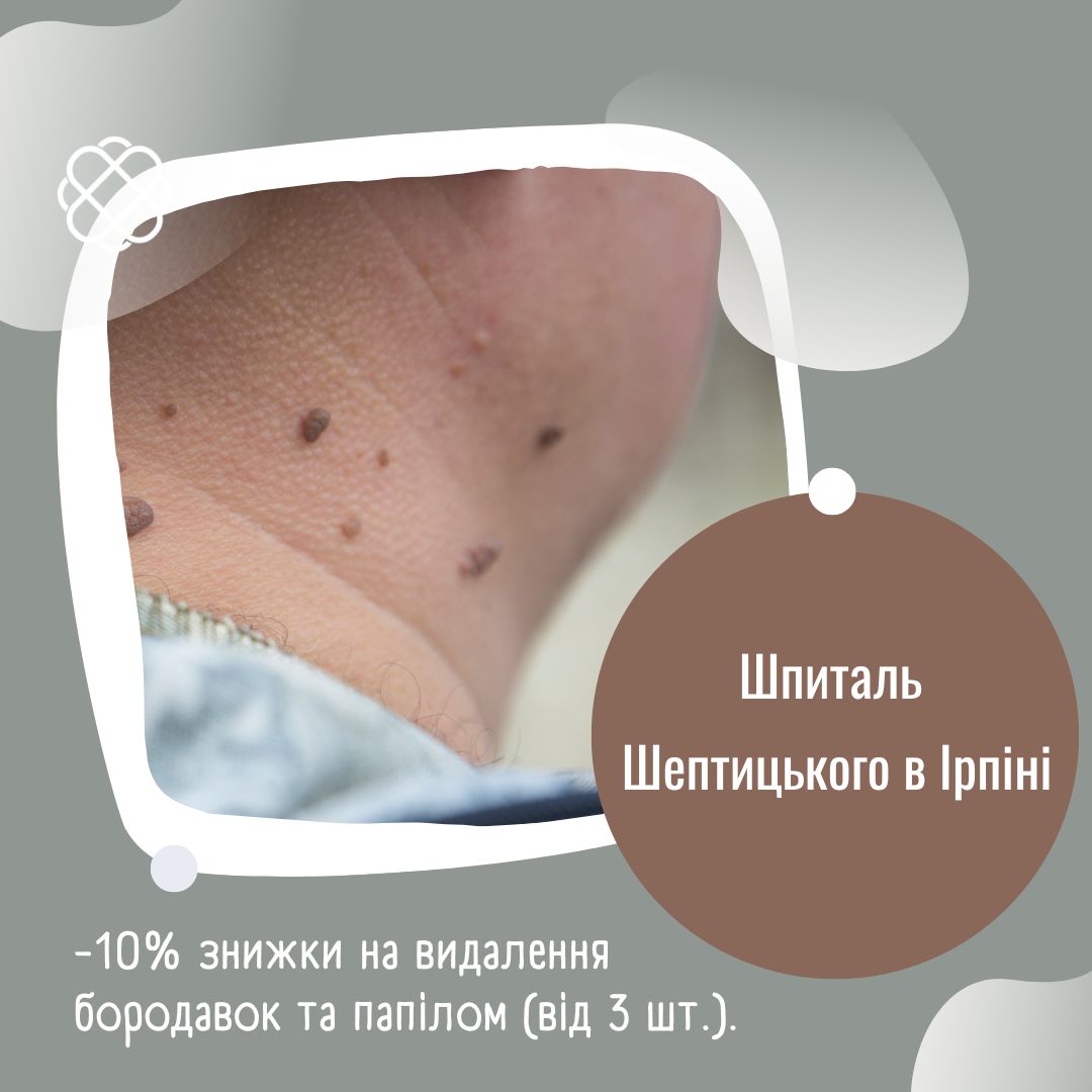 -10% знижки на видалення бородавок та папілом (від 3 шт.) Шпиталь Шептицького Ірпінь