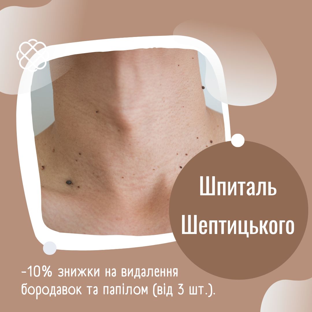 -10% знижки на видалення бородавок та папілом Шпиталь Шептицького Львів