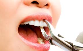 -15% скидка на удаление зуба в Giorno Dentale