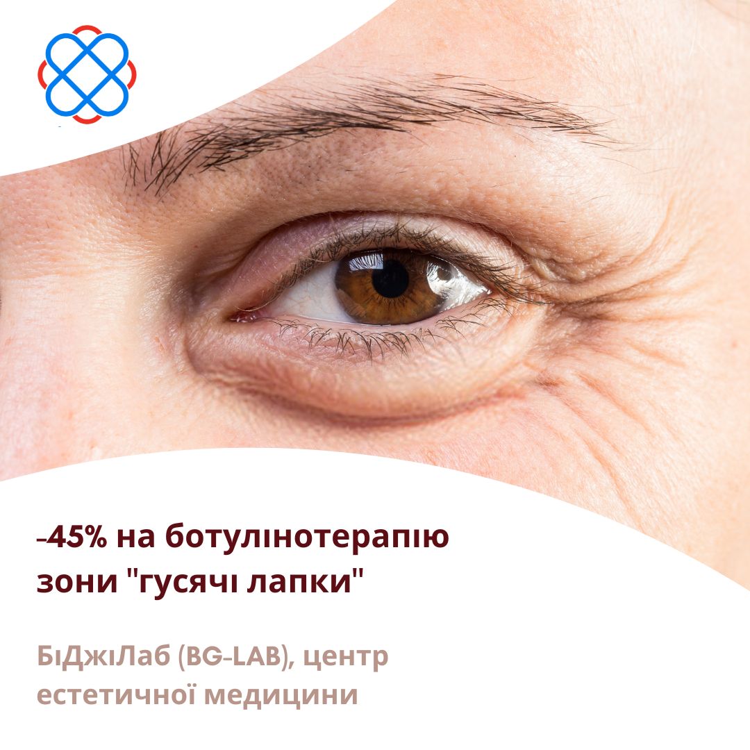 -45% на ботулінотерапію зони "гусячі лапки"