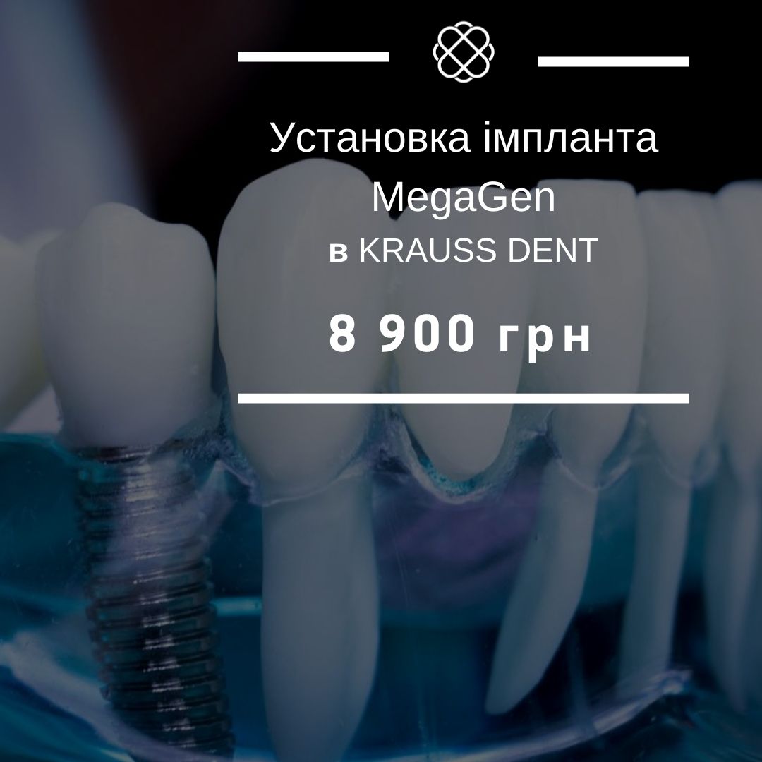 Чесна ціна на установку імпланта MegaGen 8900 грн у стоматології Краусс дент