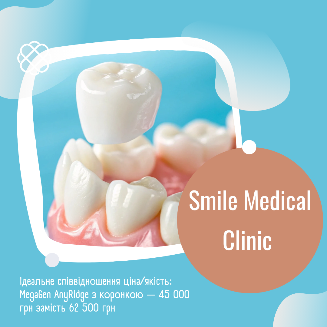 Ідеальне співвідношення ціна/якість: MegaGen AnyRidge з коронкою — 45 000 грн замість 62 500 грн в Смайл Медікал Клінік