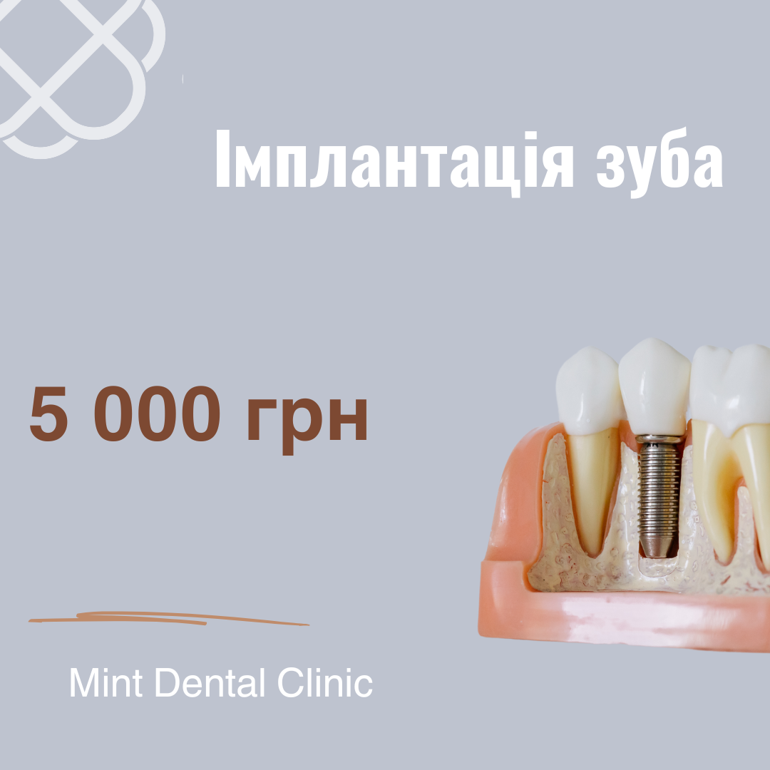 Імплантація зуба всього за 5 000 грн!