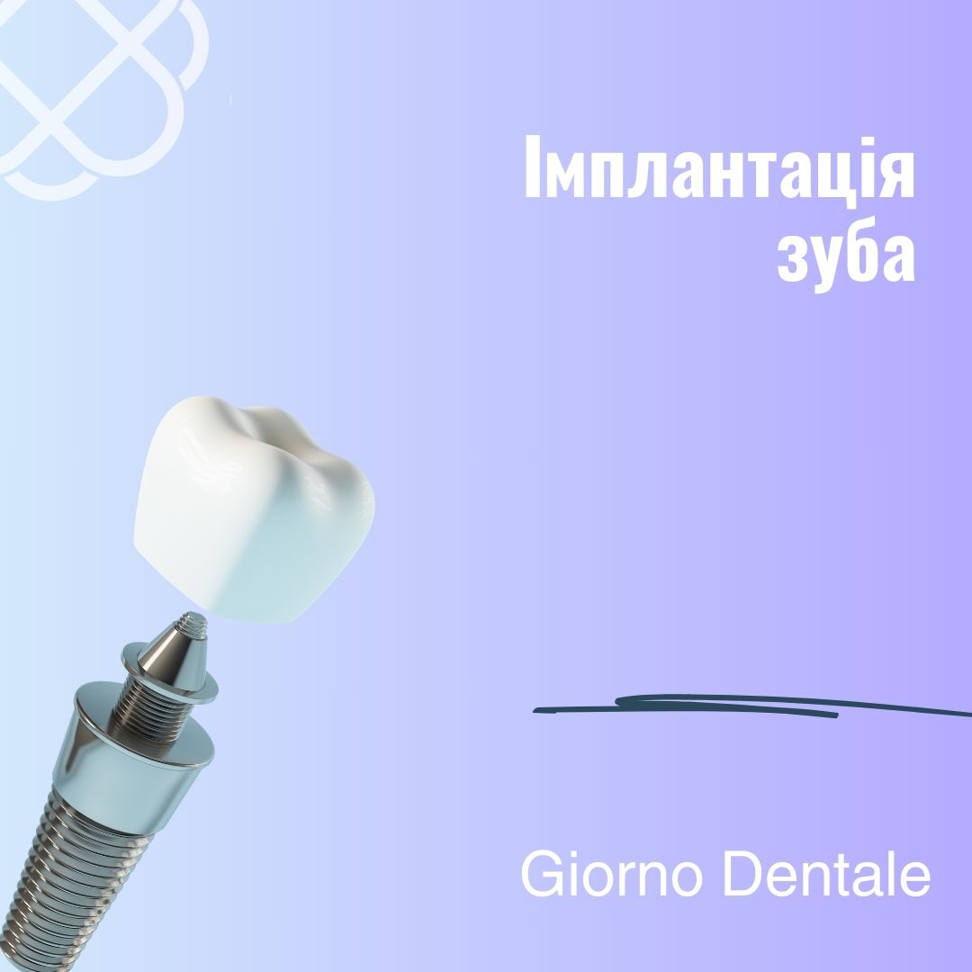 Імплантація зуба всього за 5 500 грн в Giorno Dentale 