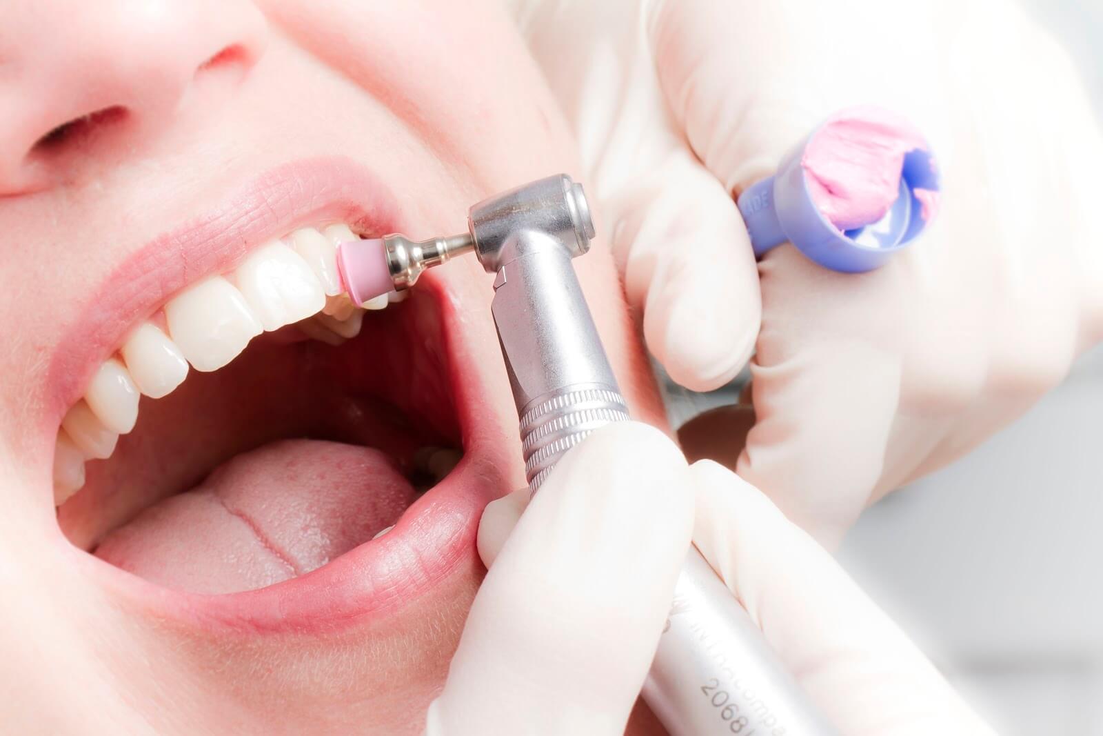 Комплексна гігієна зубів зі знижкою 50% в Viva