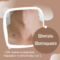 -10% знижки на видалення бородавок та папілом (від 3 шт.) Шпиталь Шептицького Львів