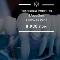 Чесна ціна на установку імпланта MegaGen 8900 грн у стоматології Краусс дент
