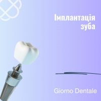 Імплантація зуба всього за 5 500 грн в Giorno Dentale 