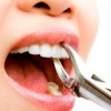 -15% скидка на удаление зуба в Giorno Dentale