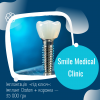 Імплантація «під ключ»: імплант Osstem + коронка — 35 000 грн в Смайл Медікал Клінік