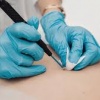 Пакет «Удаление новообразований на коже»  в МЦ Доступный доктор – 10 %