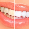 Скидка 60% на лазерное отбеливание зубов от МЦ Моя клиника на м. Позняки