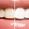 Скидка -50% на отбеливание зубов лампой в сети Astra Dent
