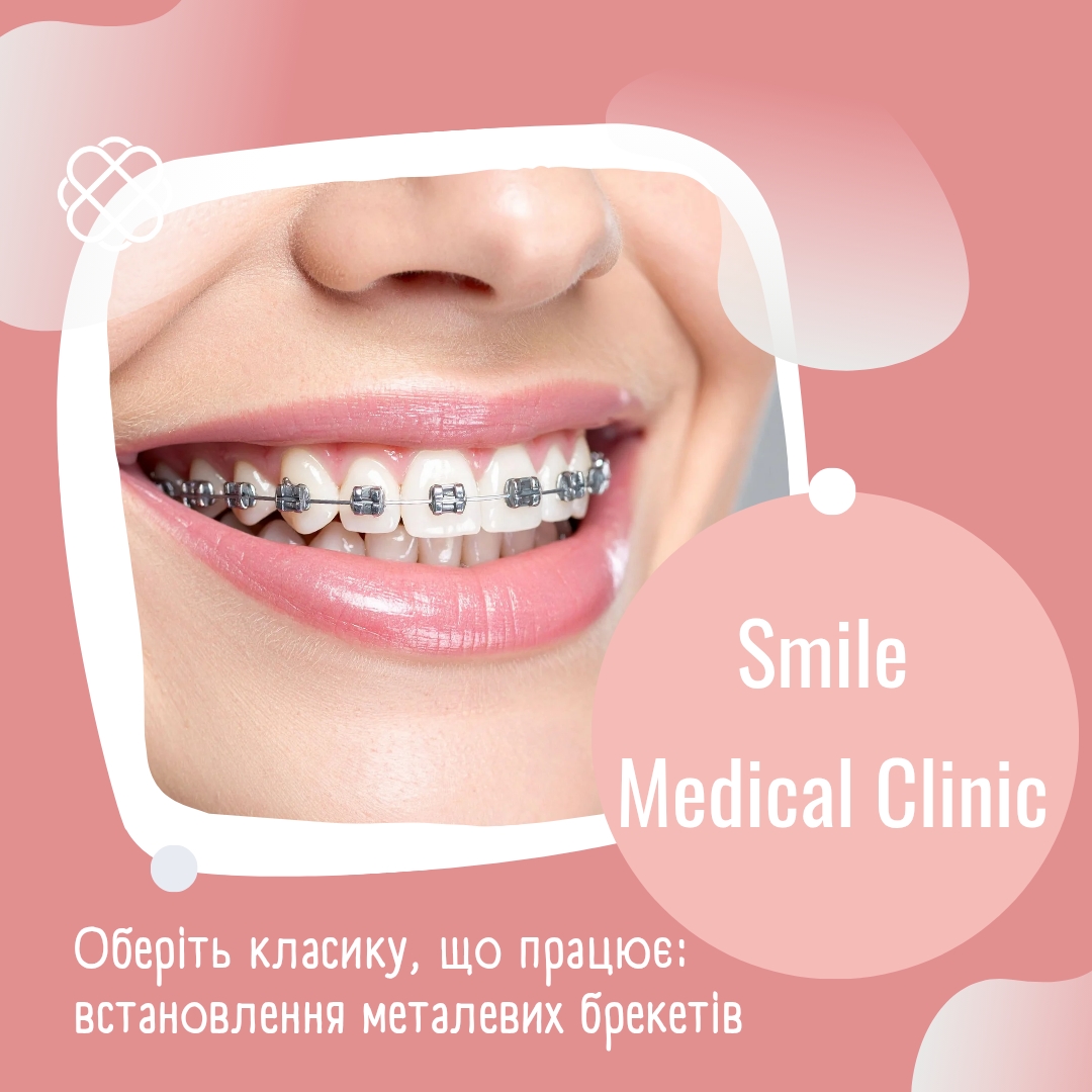 Оберіть класику, що працює: встановлення металевих брекетів — 38000 грн в Смайл Медікал Клінік!
