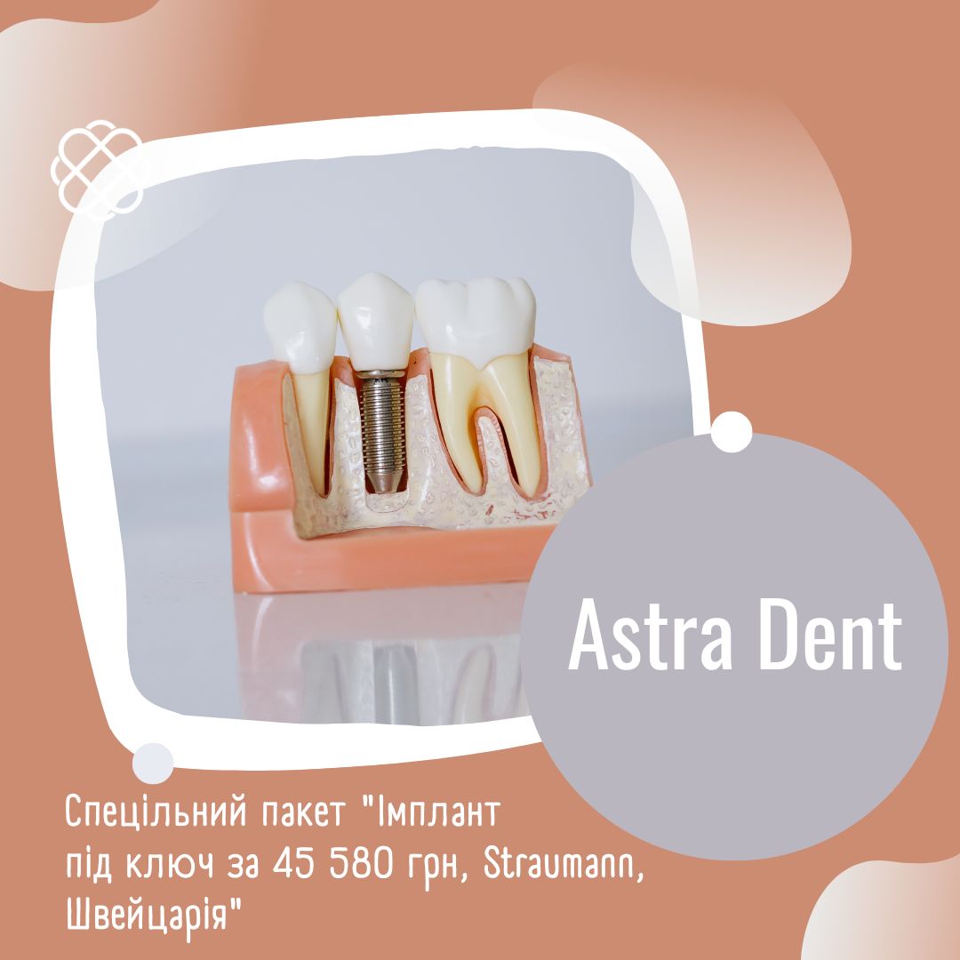Спецільний пакет "Імплант під ключ за 45 580 грн, Straumann, Швейцарія"