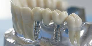 Во всех стоматологиях сети Astra Dent: Имплант MIS C1 (Израиль) по акционной цене