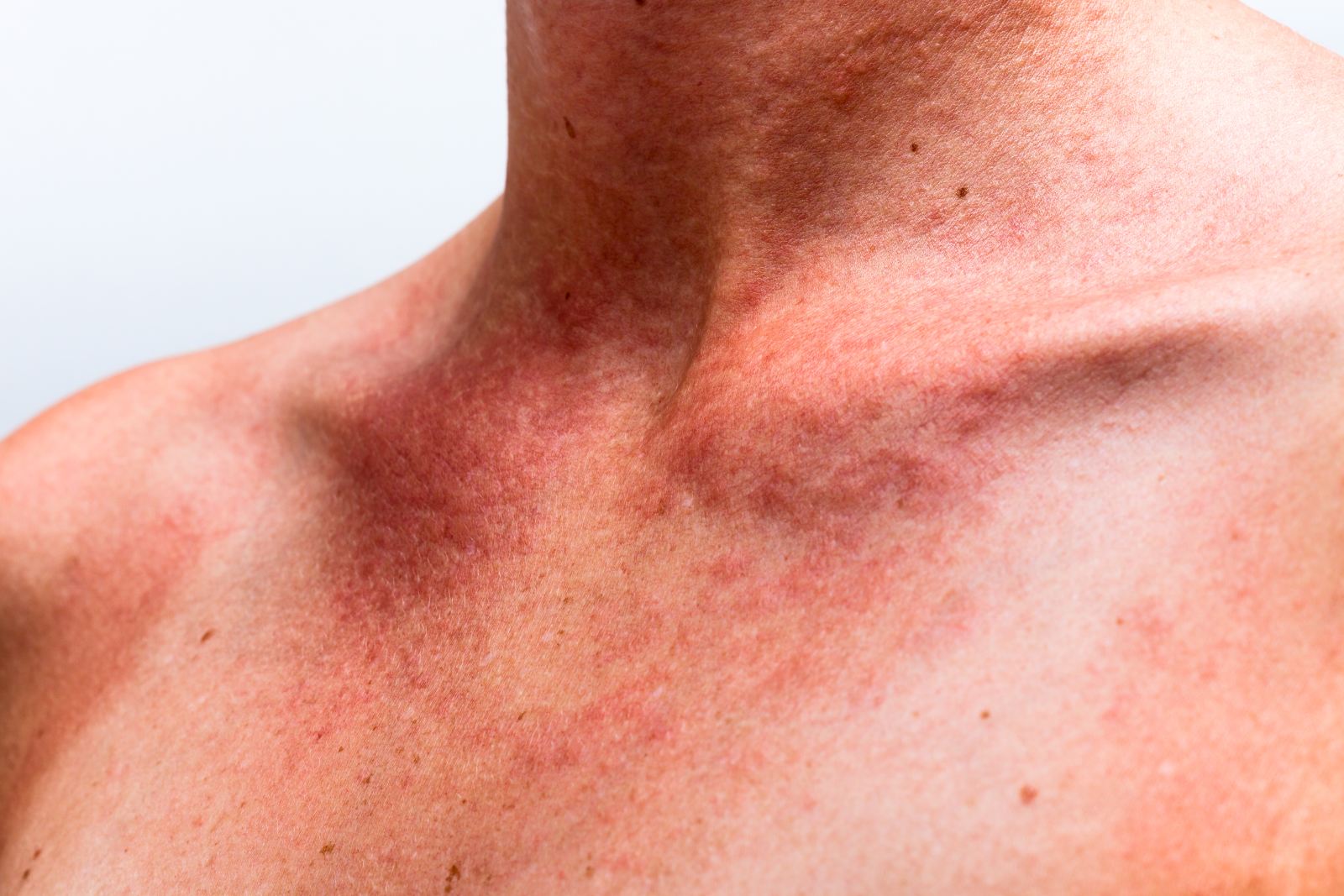 Аллергия на косметику: как ее предотвратить, обнаружить и вылечить