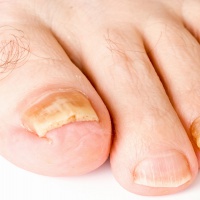 Как лечить утолщенные ногти?