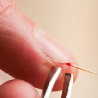 Особенности шишек на пальце: причины, особенности и методы лечения