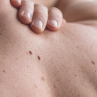 Невус – звичайний дефект шкіри чи небезпечна патологія?
