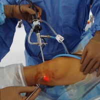 Операции на коленном суставе