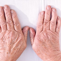 Полиартрит: искривление пальцев ног или рук