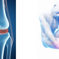 Повреждение и разрыв мениска коленного сустава