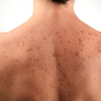 Черные точки на лице: причины появления комедонов, симптомы и лечение акне, процедура чистки кожи