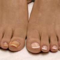 Причины желтизны ногтей