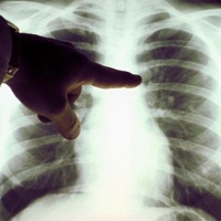 Рентгеновское исследование легких