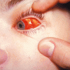 Что делать при кровоизлиянии в глаз?