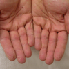О чем свидетельствуют трещины на пальцах рук или ног?