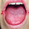Почему появляются трещины в уголках губ