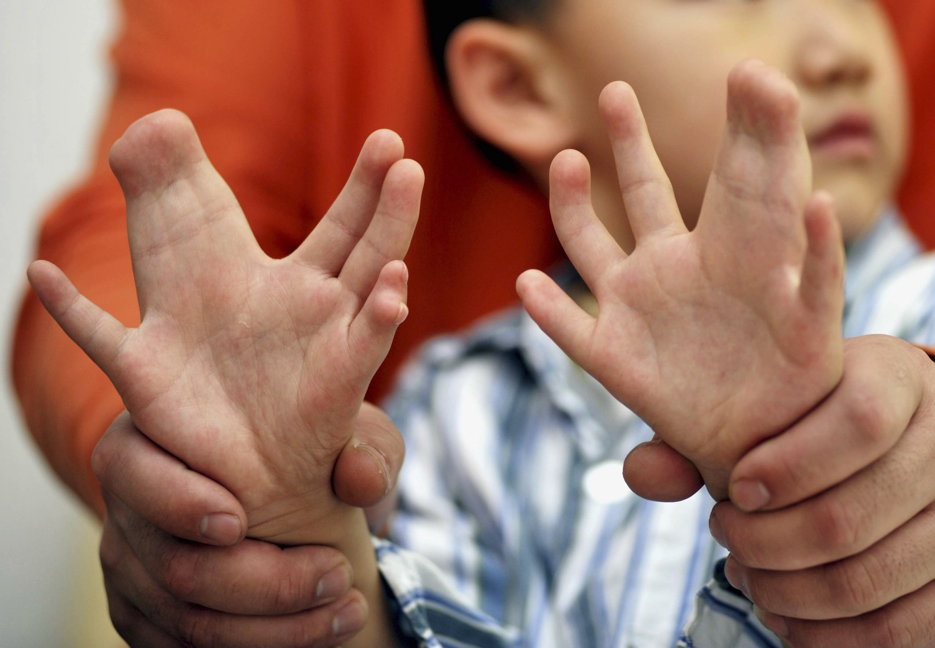 6 пальцев на руках у детей