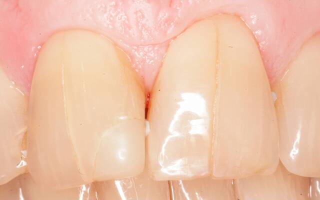 Откуда берутся трещинки на зубах?