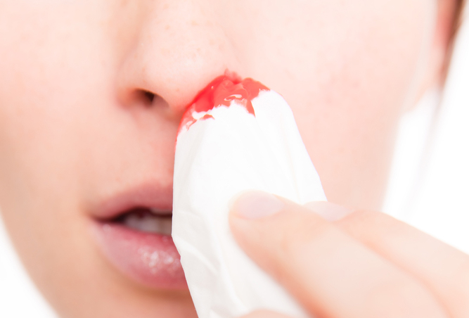 Кровотечения из носа у детей