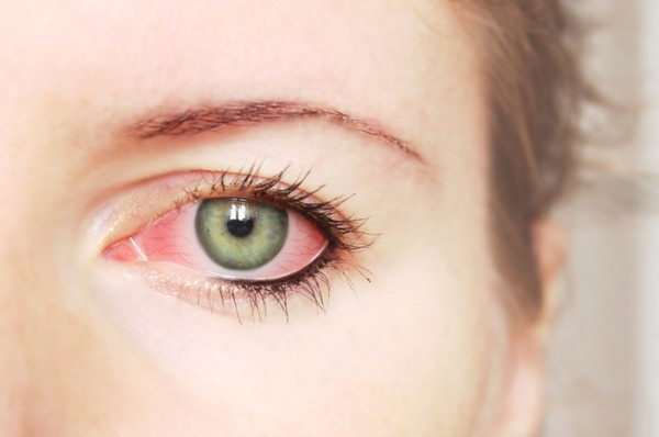 Покраснение глаз: усталость или болезнь?