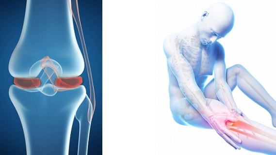 Повреждение и разрыв мениска коленного сустава