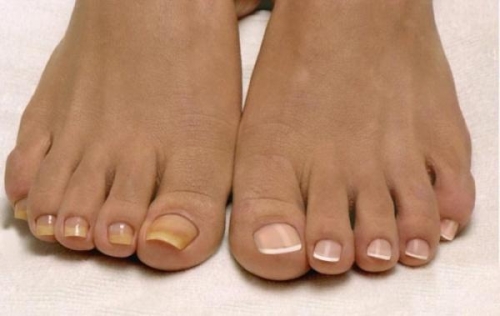 Причины желтизны ногтей