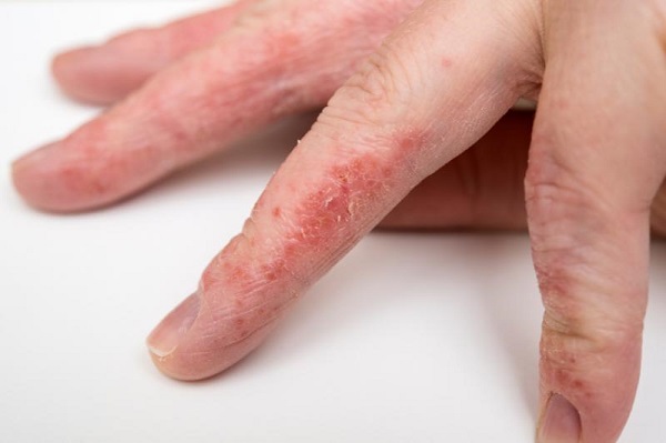 Ксероз кожи: признаки и симптомы