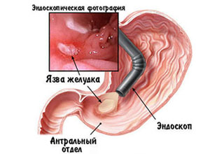 Язвы желудка, лечение язвенной болезни желудка