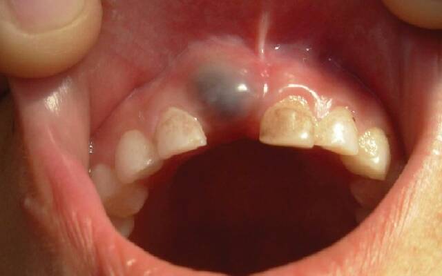 Киста зуба - симптомы и лечение кистозного образования.