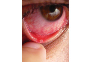 Ксерофтальмия (синдром сухого глаза)